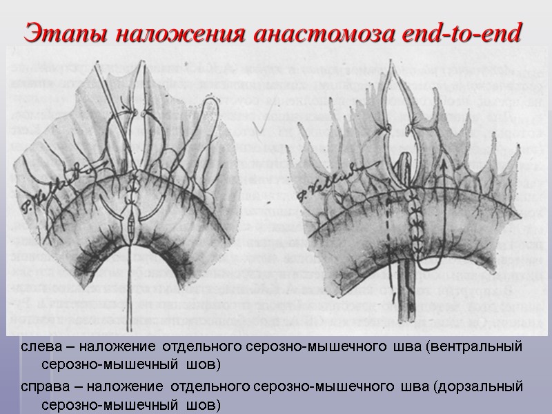 Этапы наложения анастомоза end-to-end слева – наложение отдельного серозно-мышечного шва (вентральный серозно-мышечный шов) справа